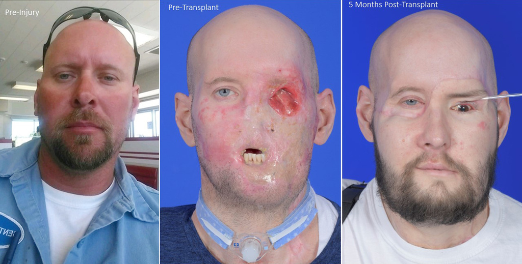 Man receives the first eye transplant plus a new face. It's a step